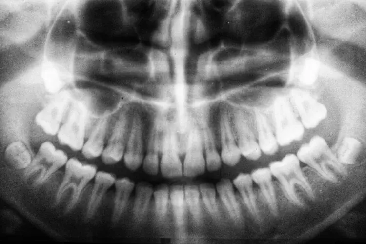 x-ray of mouth