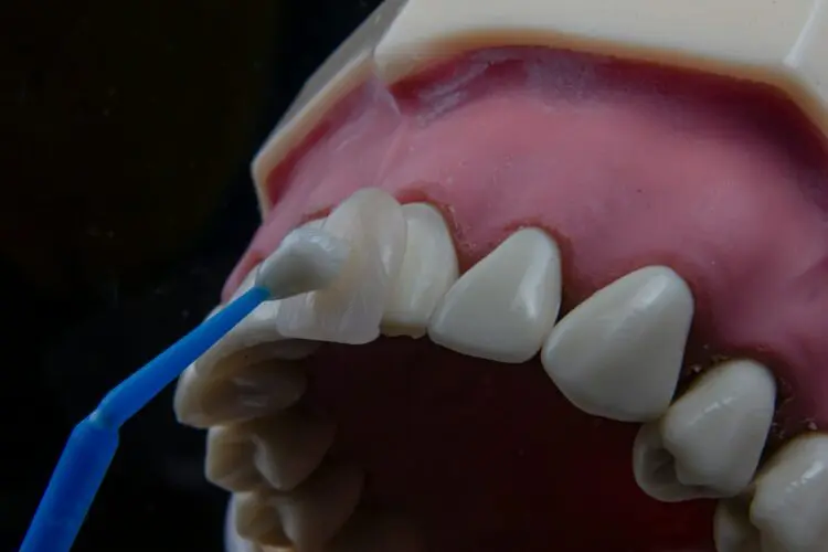 veneer being placed over natural tooth