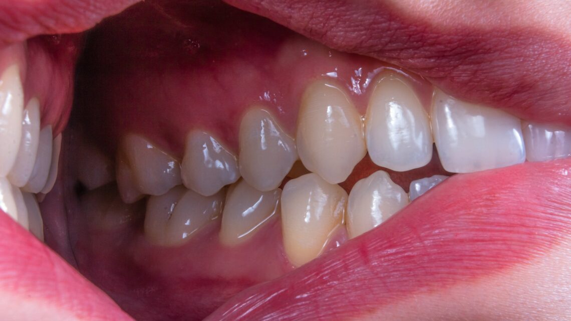 mouth with overly red gums -what do the early stages of gum disease look like