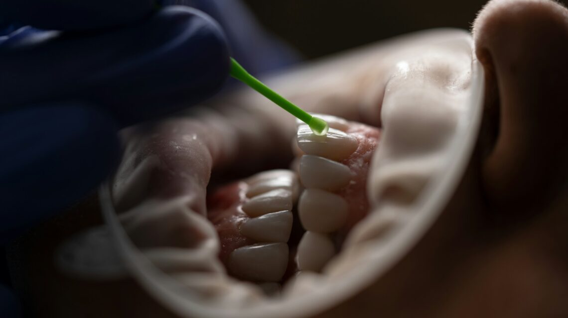 tooth undergoing procedure - what are dental veneers